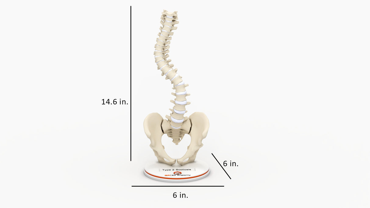 Scoliosis Type-2 Model 2