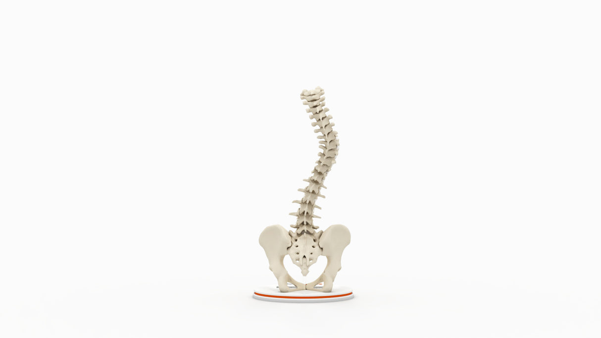 Scoliosis Type-2 Model 3
