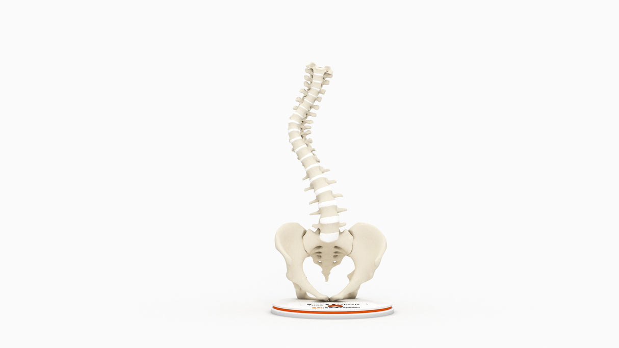 Scoliosis Type-2 Model 3