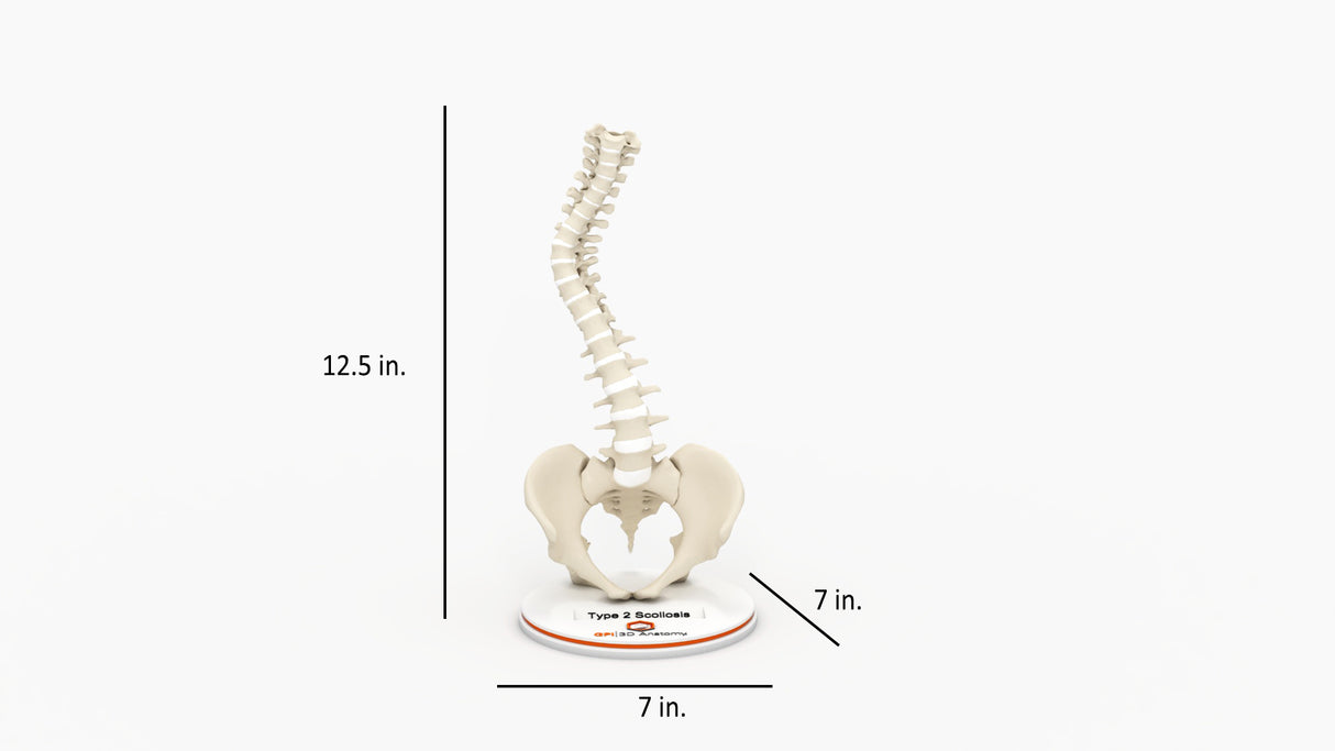 Scoliosis Type-2 Model 3