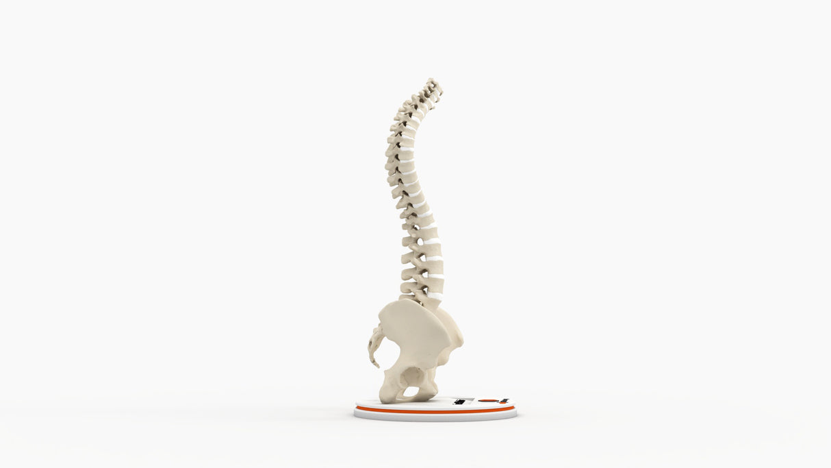 Scoliosis Type-2 Model 4