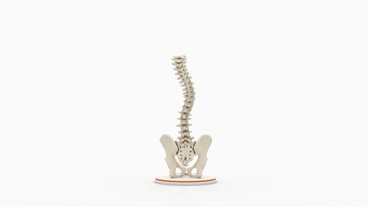 Scoliosis Type-2 Model 5