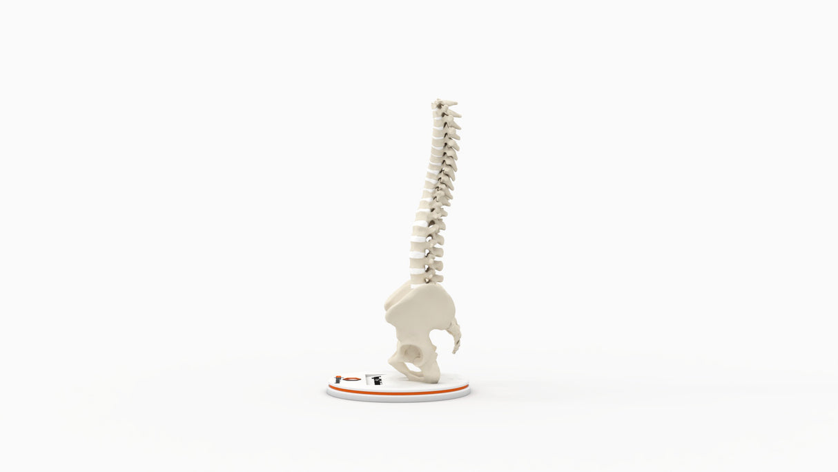Scoliosis Type-2 Model 5