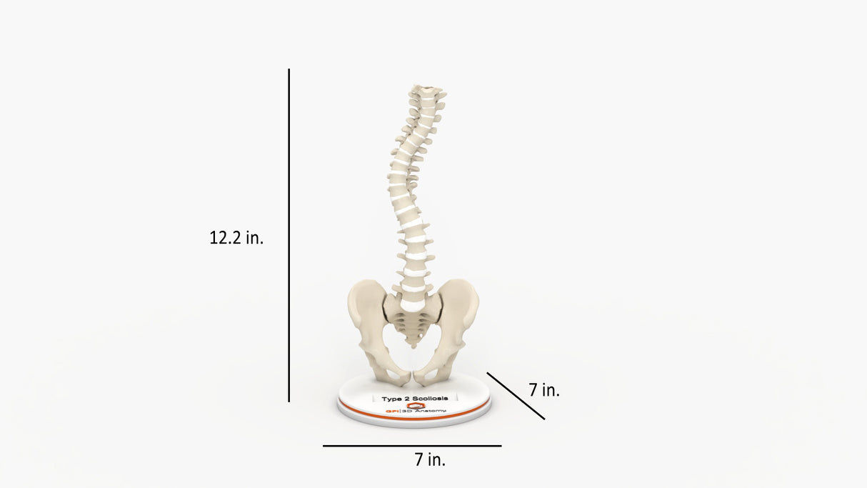 Scoliosis Type-2 Model 5
