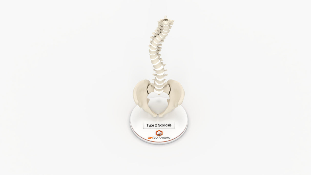 Scoliosis Type-2 Model 5