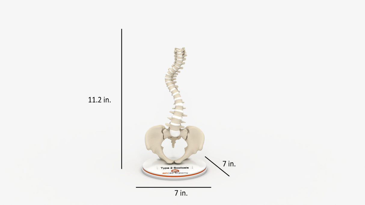 Scoliosis Type-2 Model 6