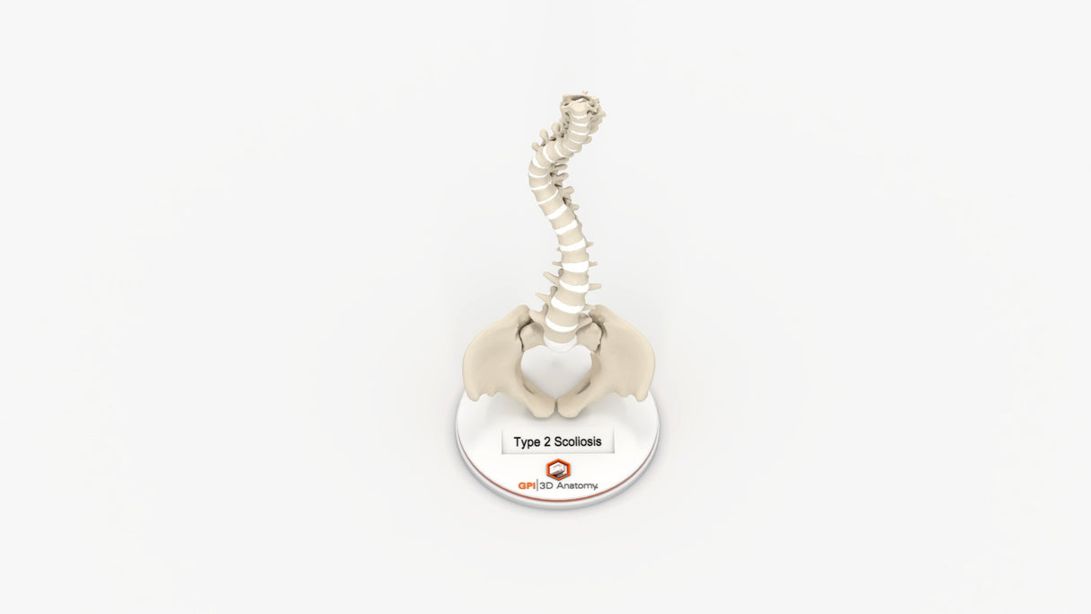 Scoliosis Type-2 Model 6