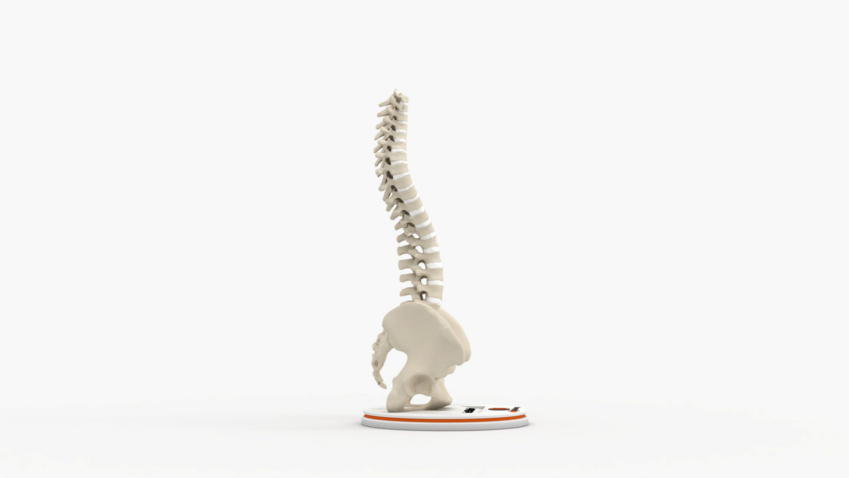 Scoliosis Type-2 Model 7