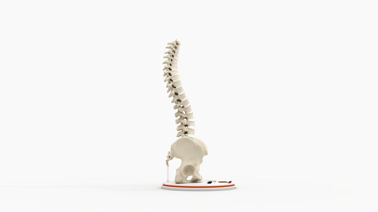 Scoliosis Type-2 Model 8