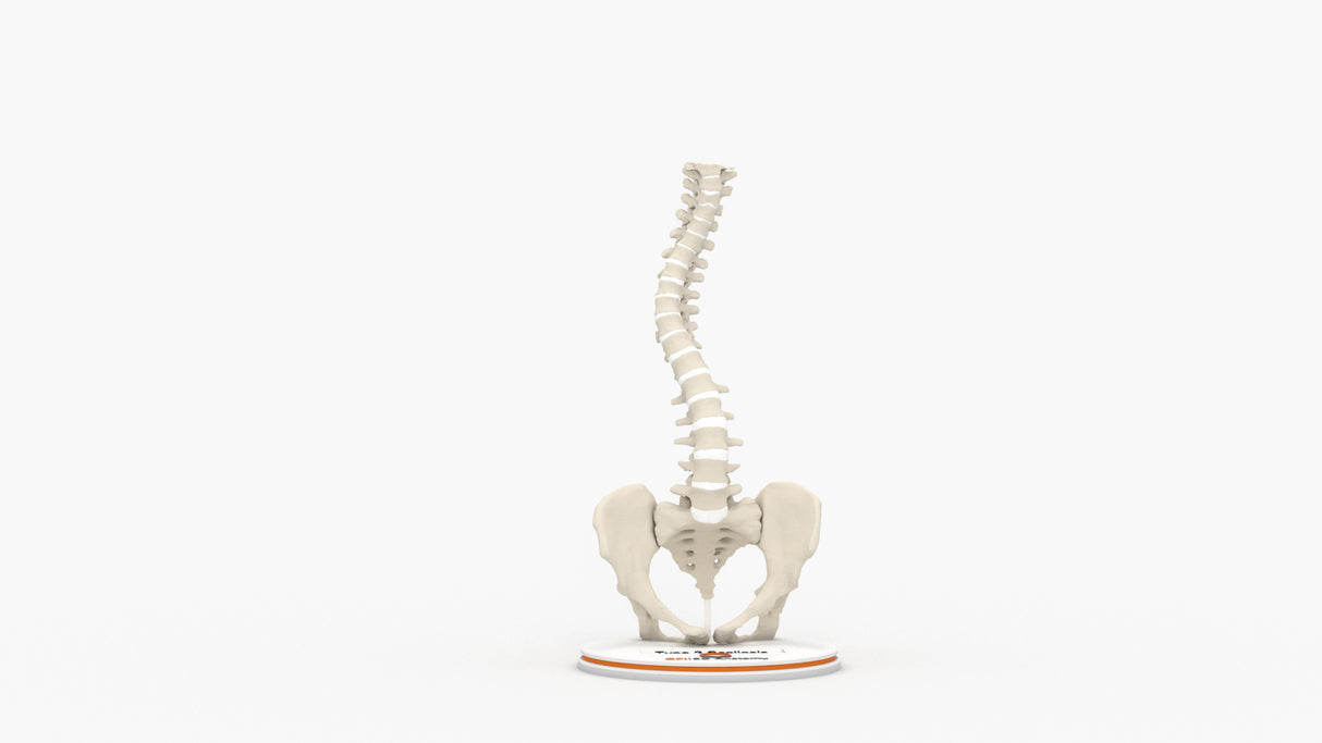 Scoliosis Type-2 Model 9