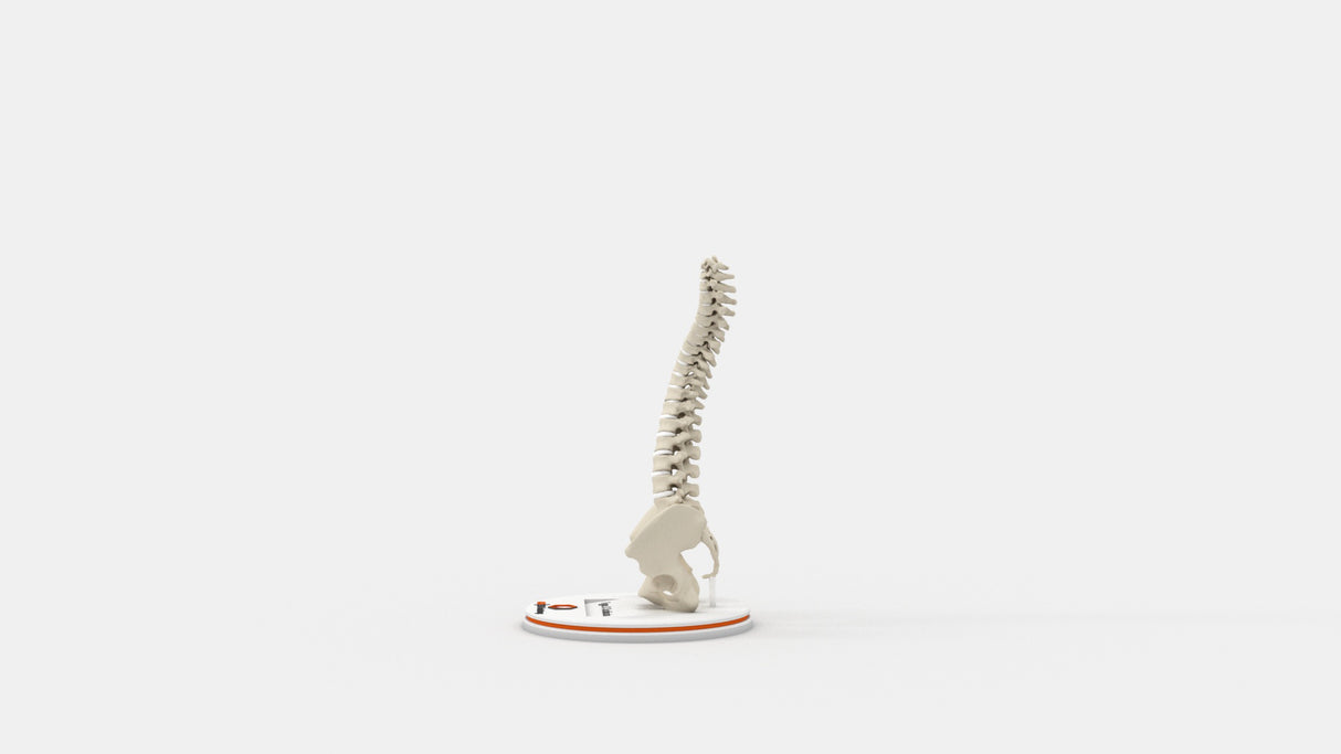 Scoliosis Type-3 Model 1