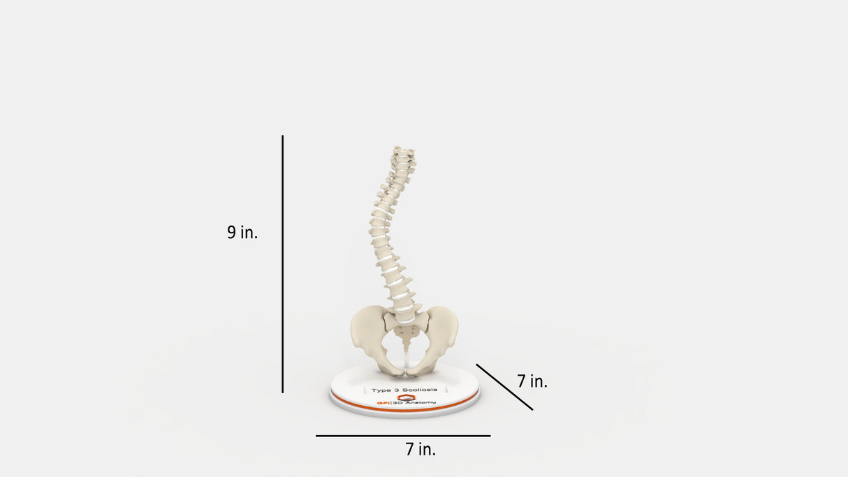 Scoliosis Type-3 Model 1