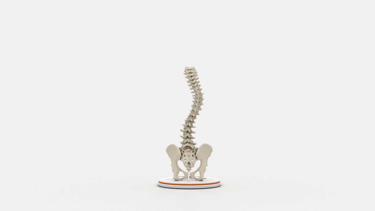 Scoliosis Type-3 Model 2