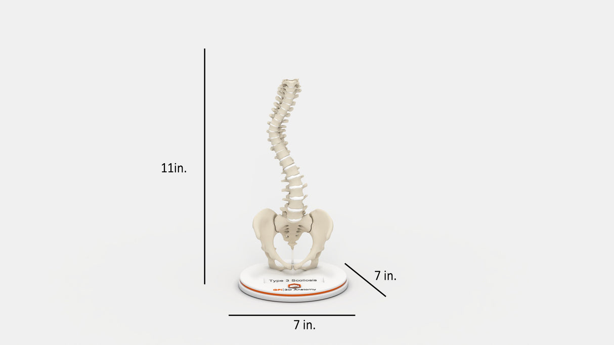 Scoliosis Type-3 Model 2