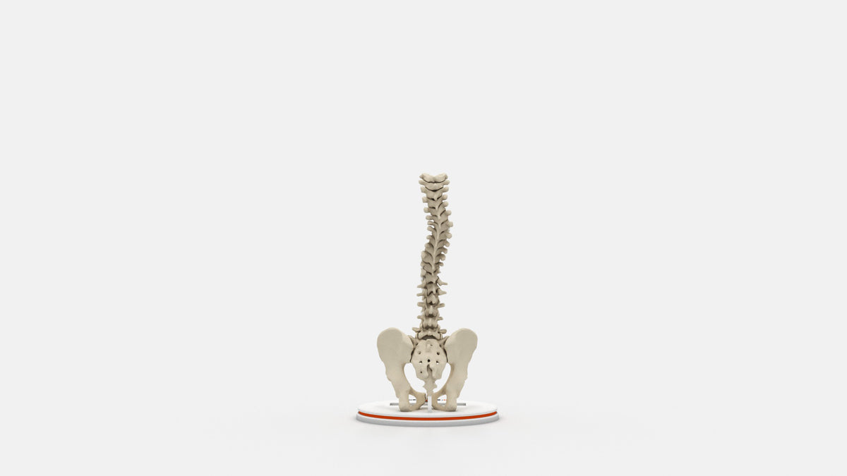 Scoliosis Type-4 Model 1