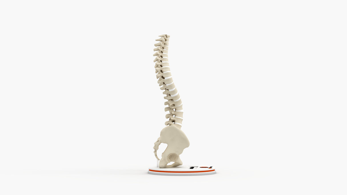 Scoliosis Type-1 Idiopathic 3