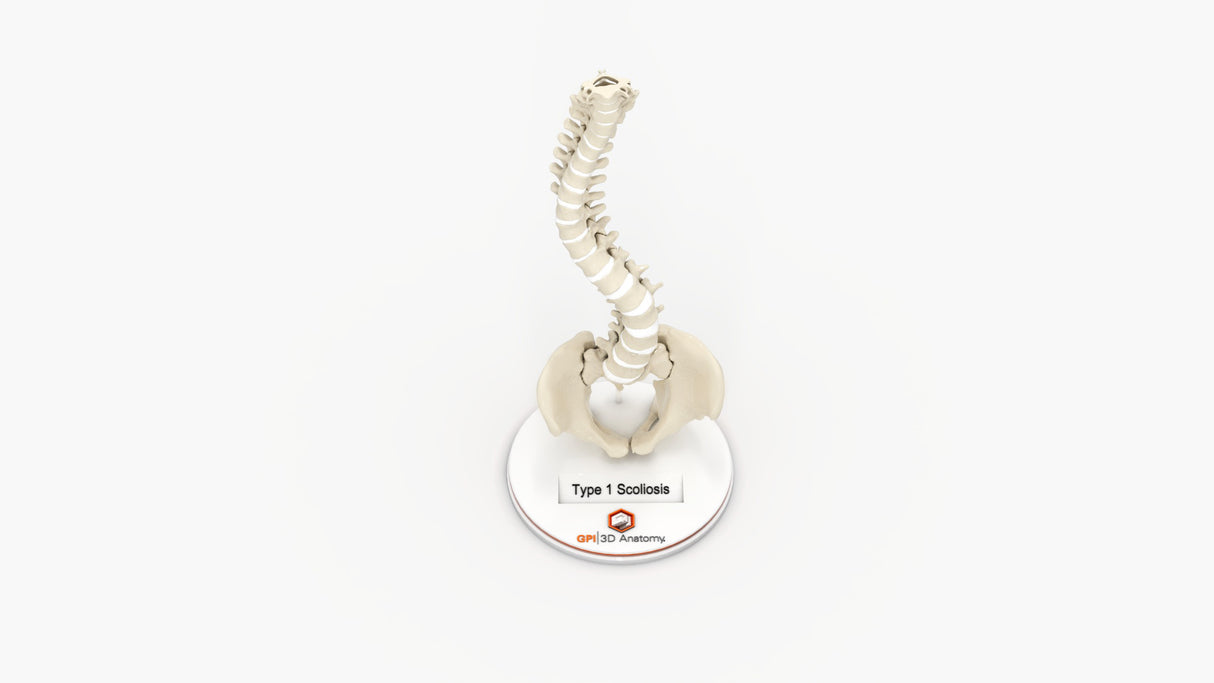 Scoliosis Type-1 Idiopathic 3
