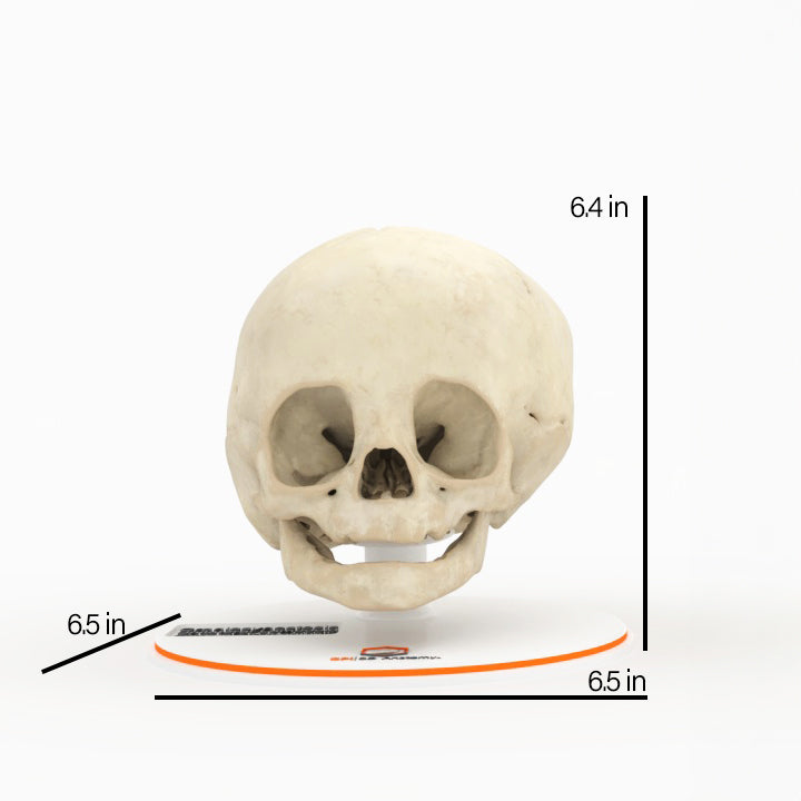 Infant Skull With Unilateral Craniosynostosis of the Lambdoid Suture - Female, 7 Months