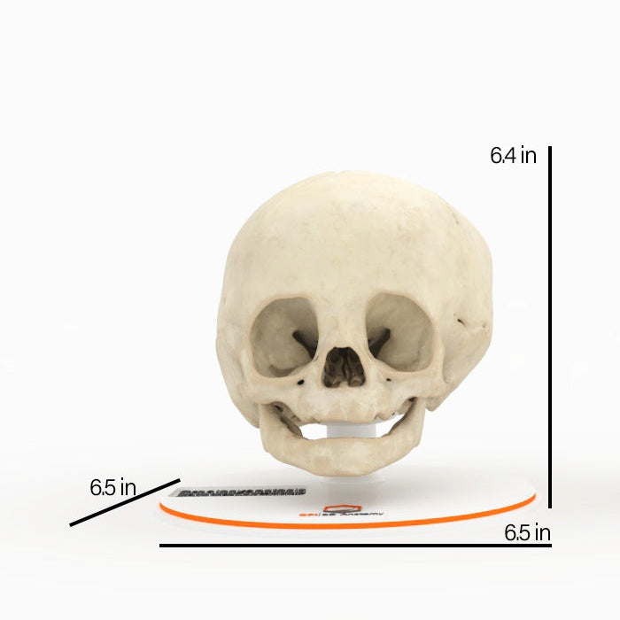Infant Skull With Unilateral Craniosynostosis of the Lambdoid Suture - Female, 7 Months