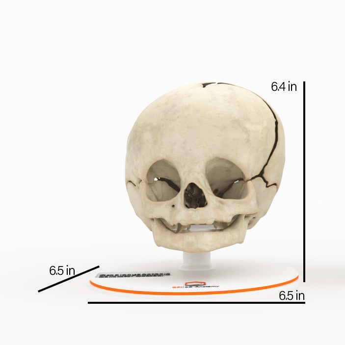 Infant Skull With Unilateral Craniosynostosis of the Coronal Suture - Male, 4 Months