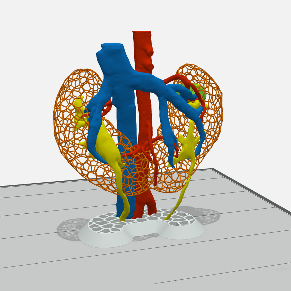 Custom 3D Anatomy Models Renal Cell Carcinoma Horseshoe Kidney