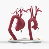 Supracoronary Ascending Aortic Aneurysm and Normal