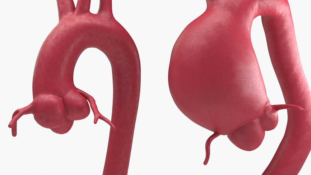 Supracoronary Ascending Aortic Aneurysm and Normal