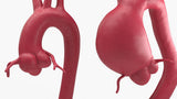 Supracoronary Ascending Aortic Aneurysm and Normal