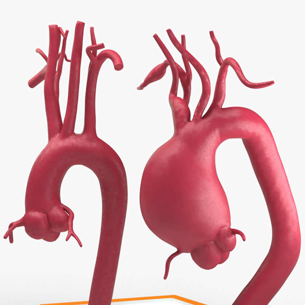 Supracoronary Ascending Aortic Aneurysm and Normal