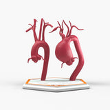 Supracoronary Ascending Aortic Aneurysm and Normal