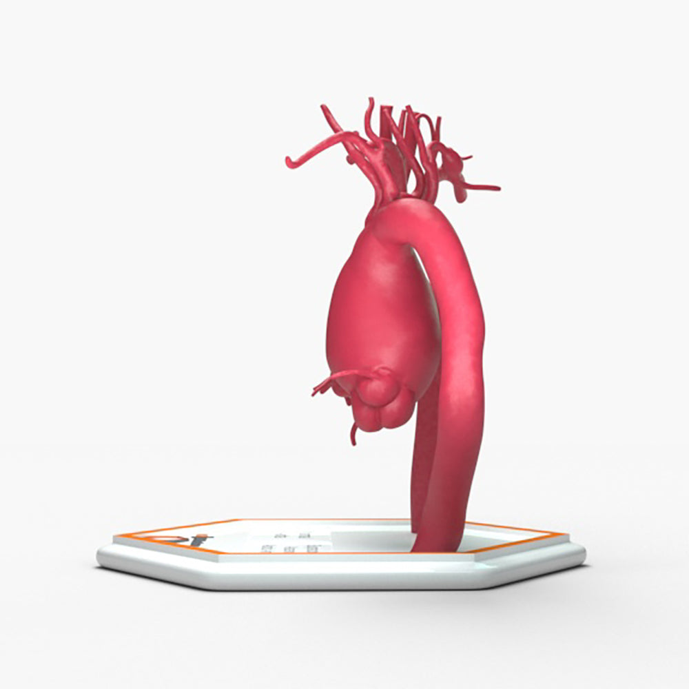 Supracoronary Ascending Aortic Aneurysm and Normal