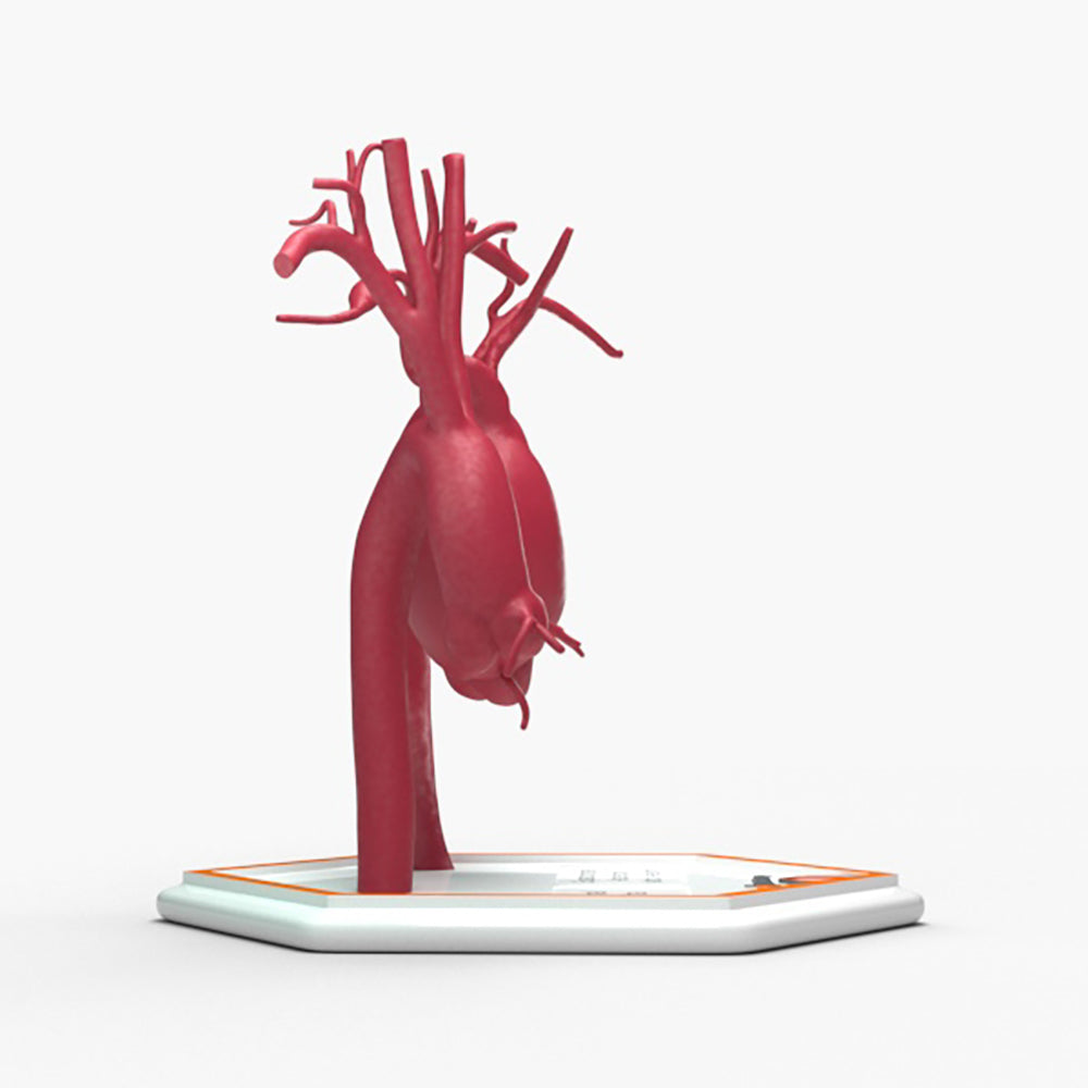 Supracoronary Ascending Aortic Aneurysm and Normal