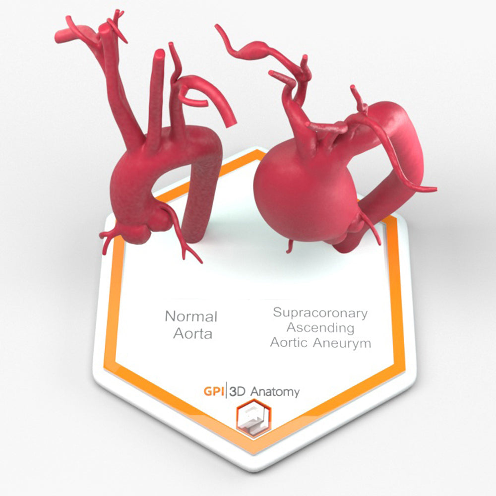 Supracoronary Ascending Aortic Aneurysm and Normal