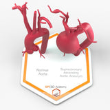 Supracoronary Ascending Aortic Aneurysm and Normal