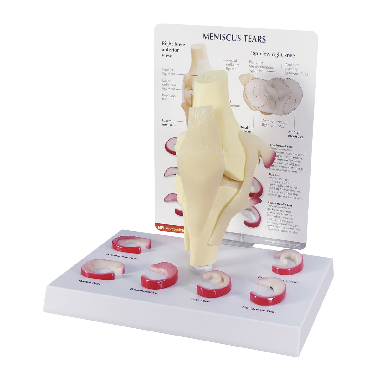 Knee Model with Meniscus Tears