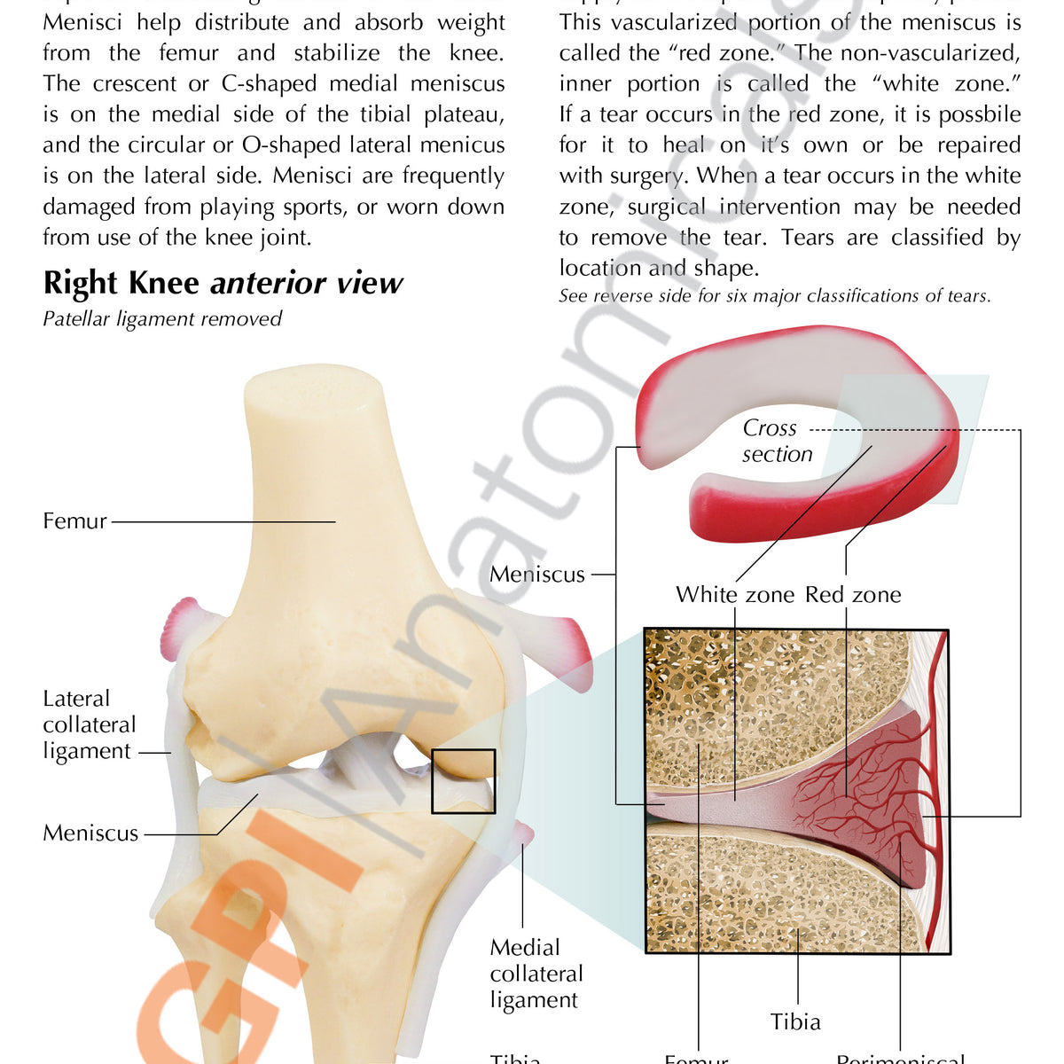Meniscus Modeled Knee Model with Meniscus Tears Education Card – GPI 3D Anatomy