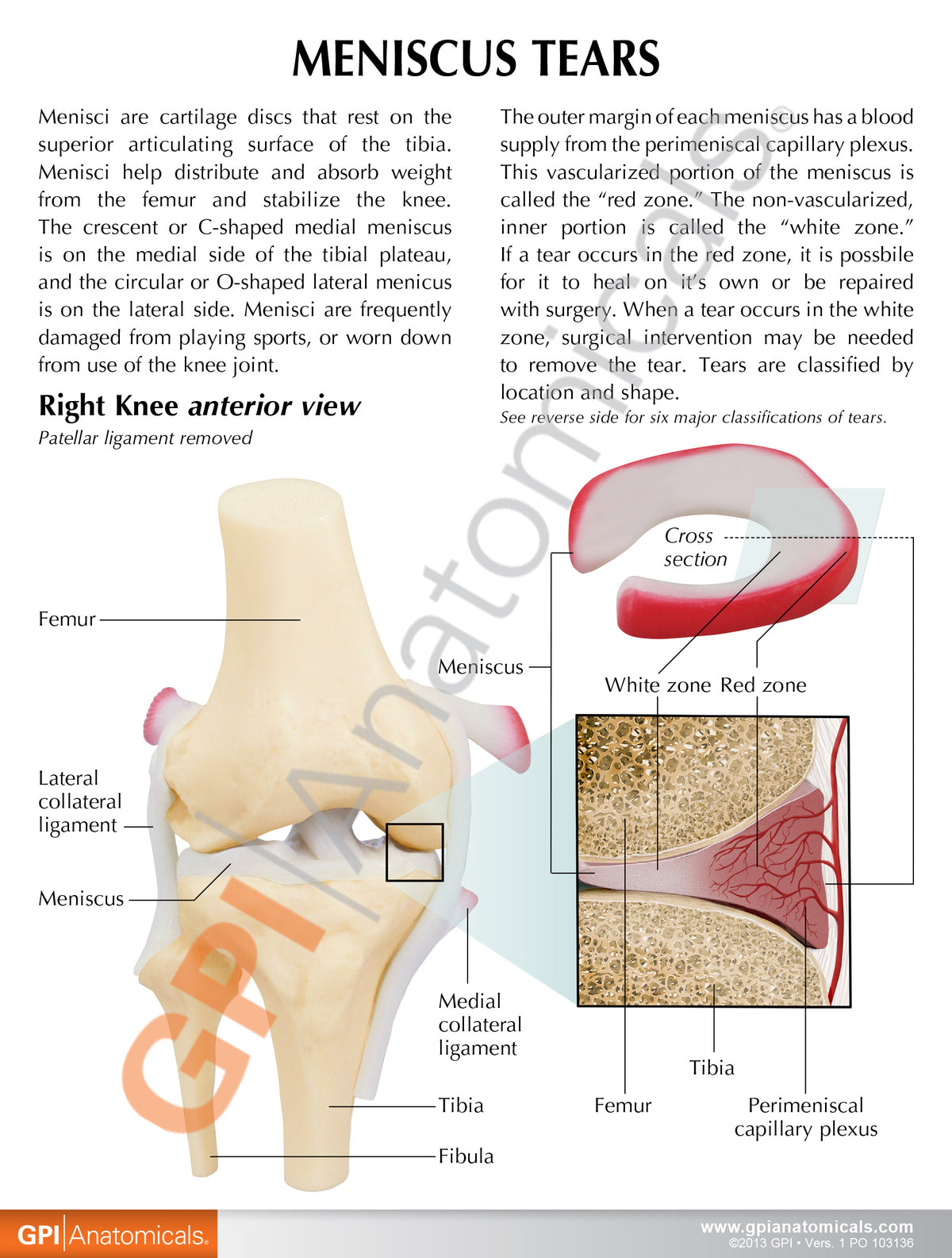 Meniscus Rupture Knee Model with Meniscus Tears – GPI 3D Anatomy