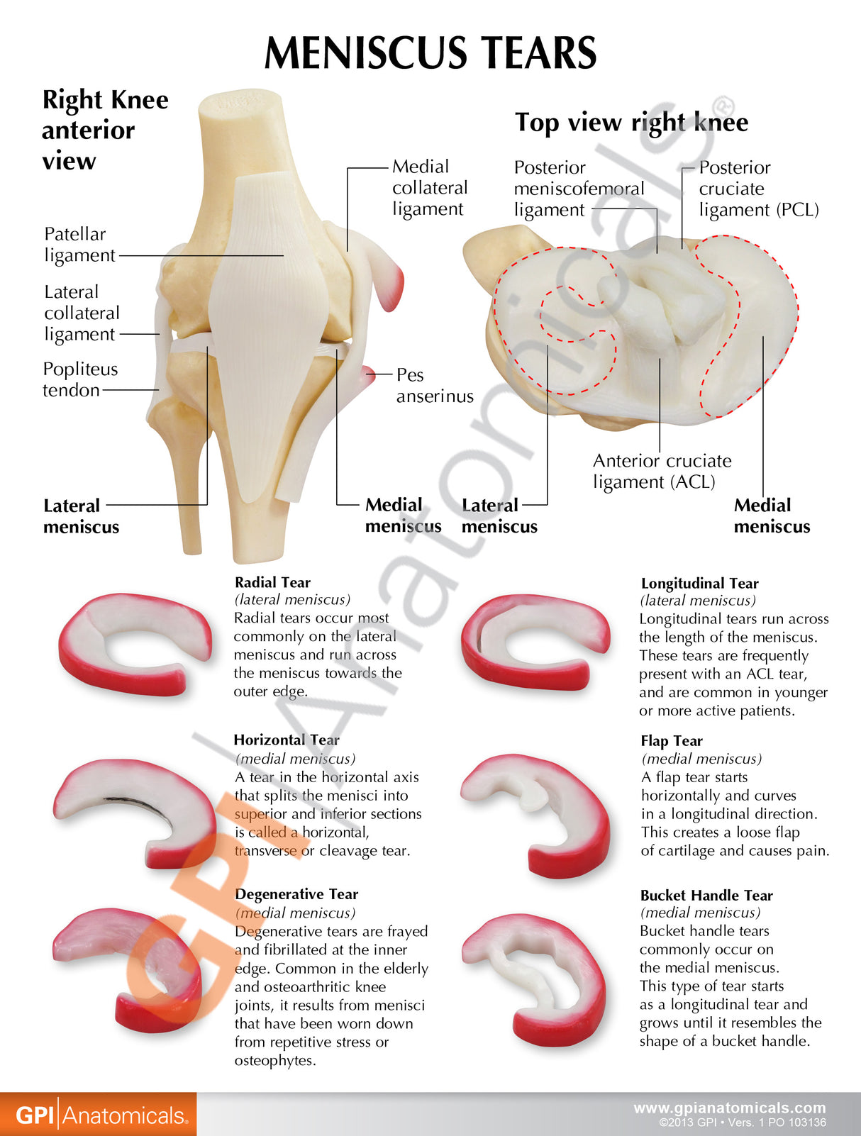 Knee Model with Meniscus Tears