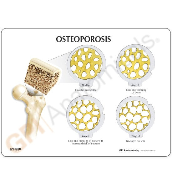 Osteoporosis Education Card