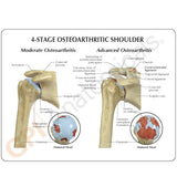 4-Stage Osteoarthritis (OA) Shoulder Model