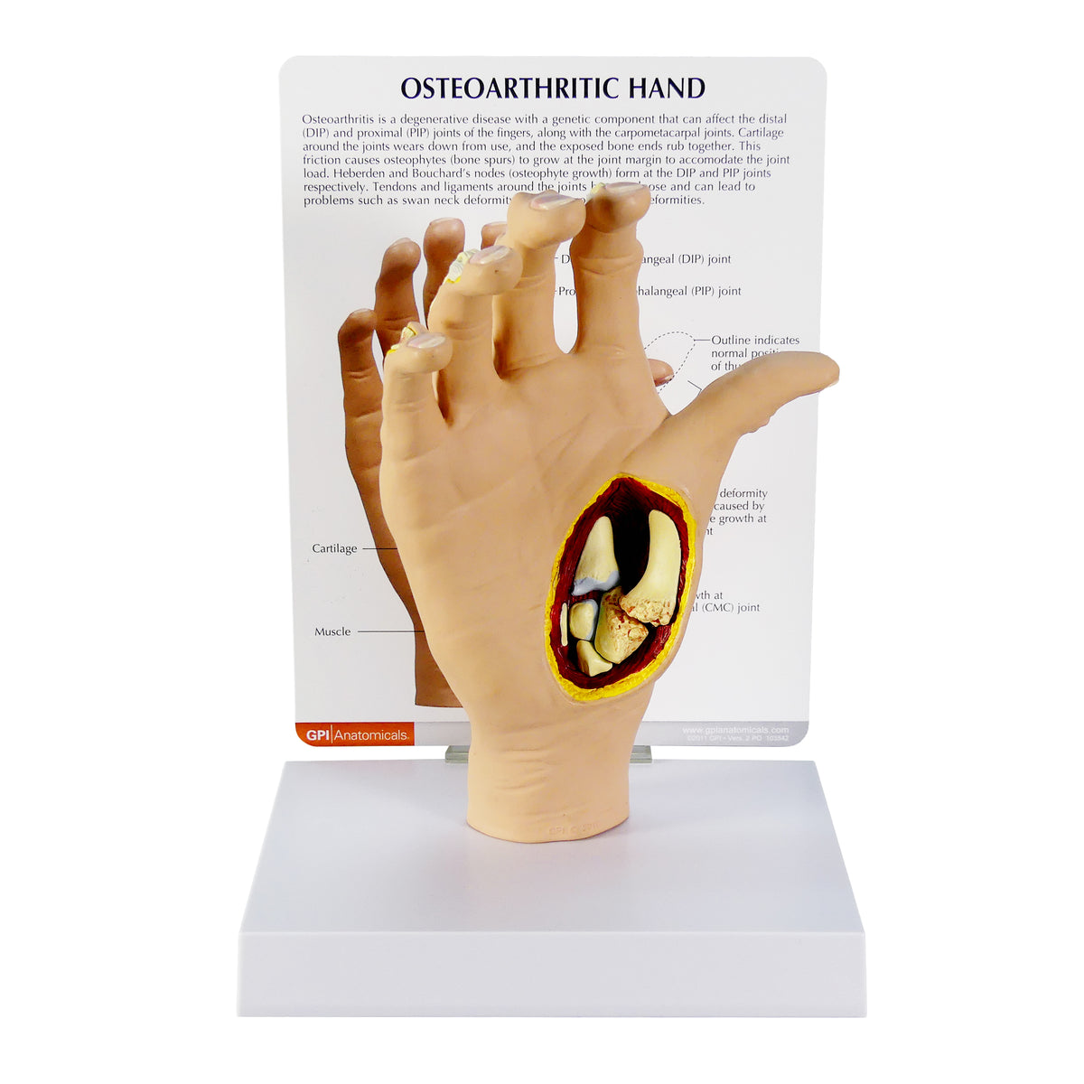 Right Hand Model with Osteoarthritis (OA) – GPI 3D Anatomy