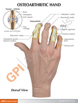Right Hand Model with Osteoarthritis (OA)