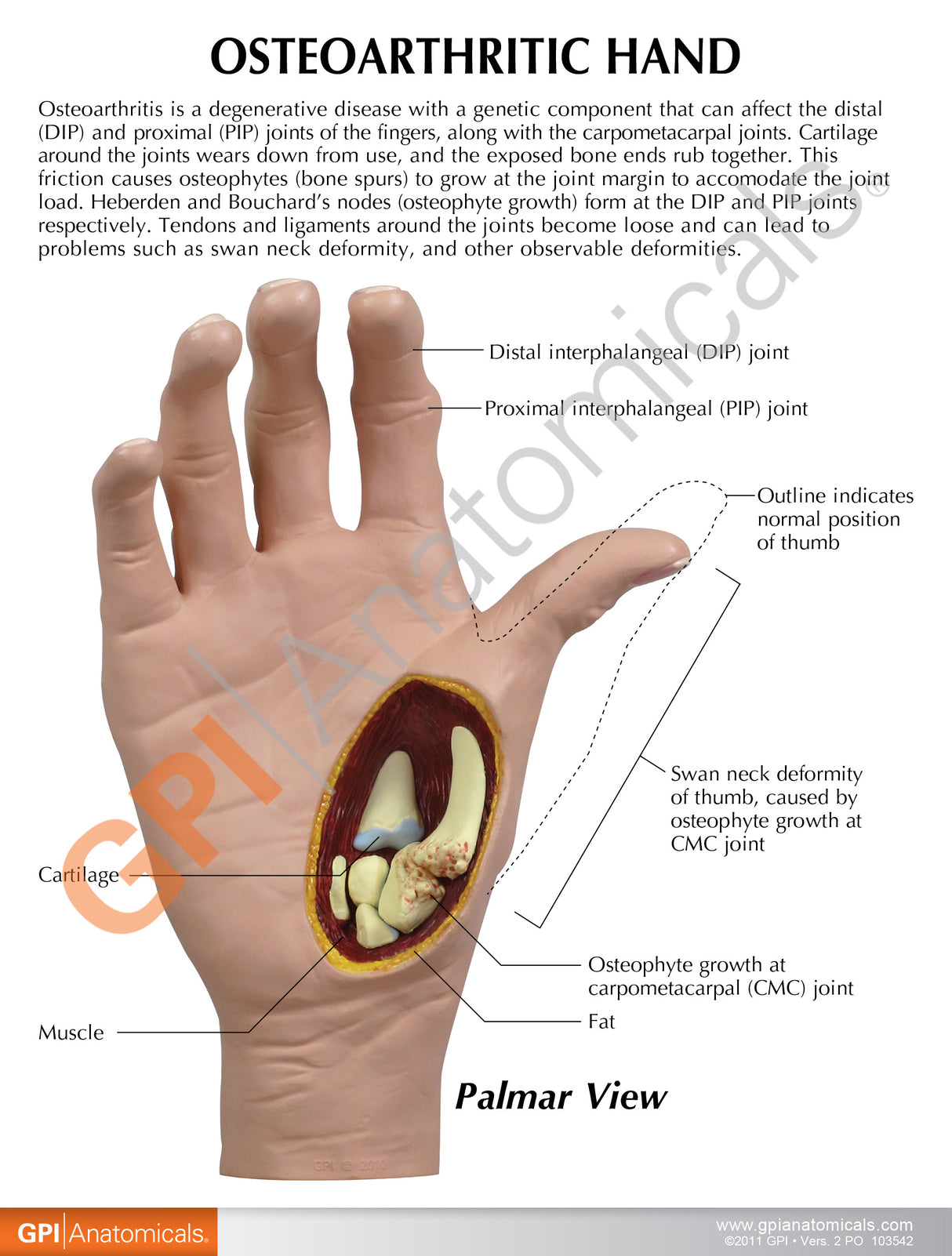 Right Hand Model with Osteoarthritis (OA)