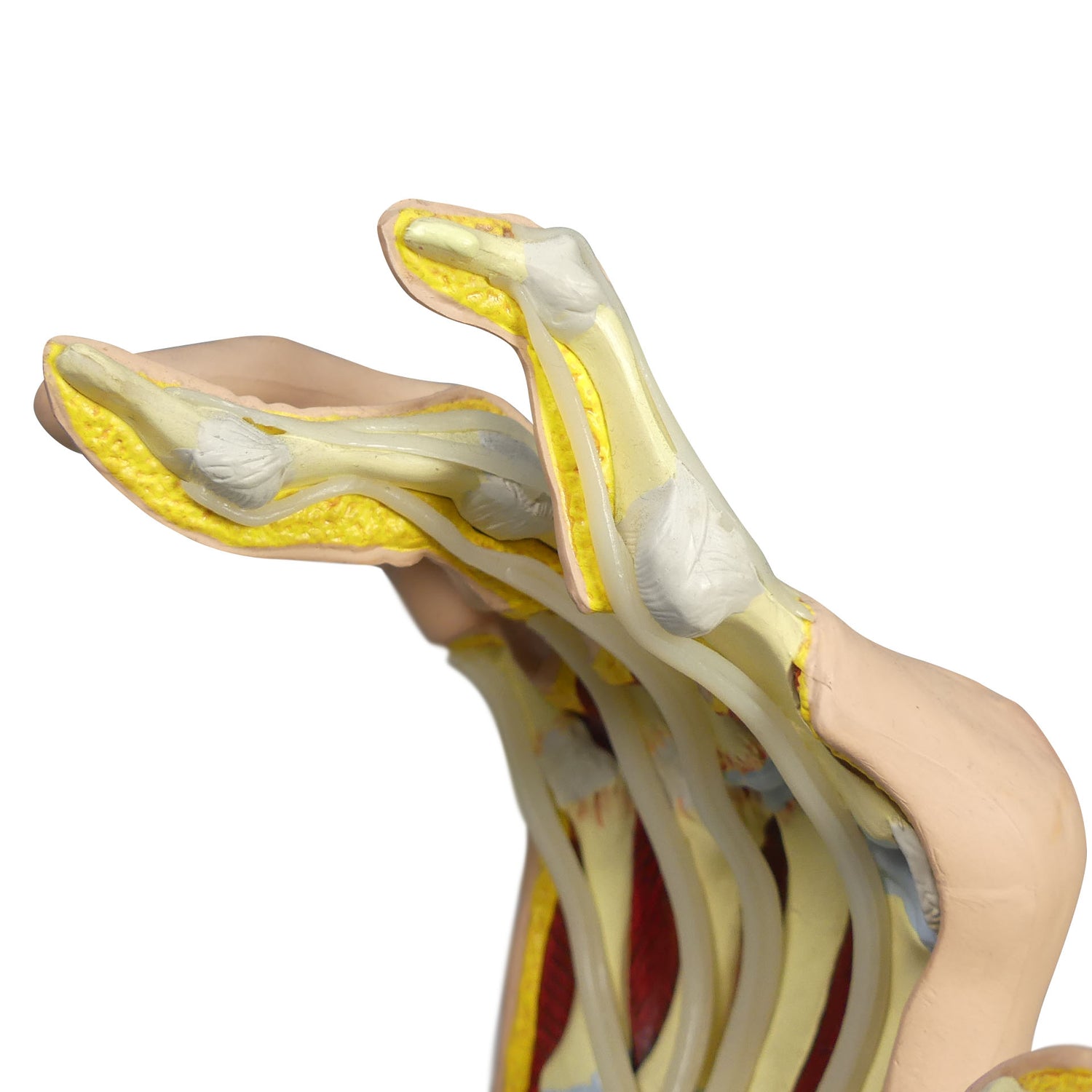 Right Hand Model with Rheumatoid Arthritis – GPI 3D Anatomy