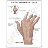Right and with Rheumatoid Arthritis Education Card