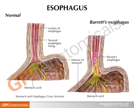4-Piece Stomach Model Set with Gastroesophageal Reflux Disease (GERD)