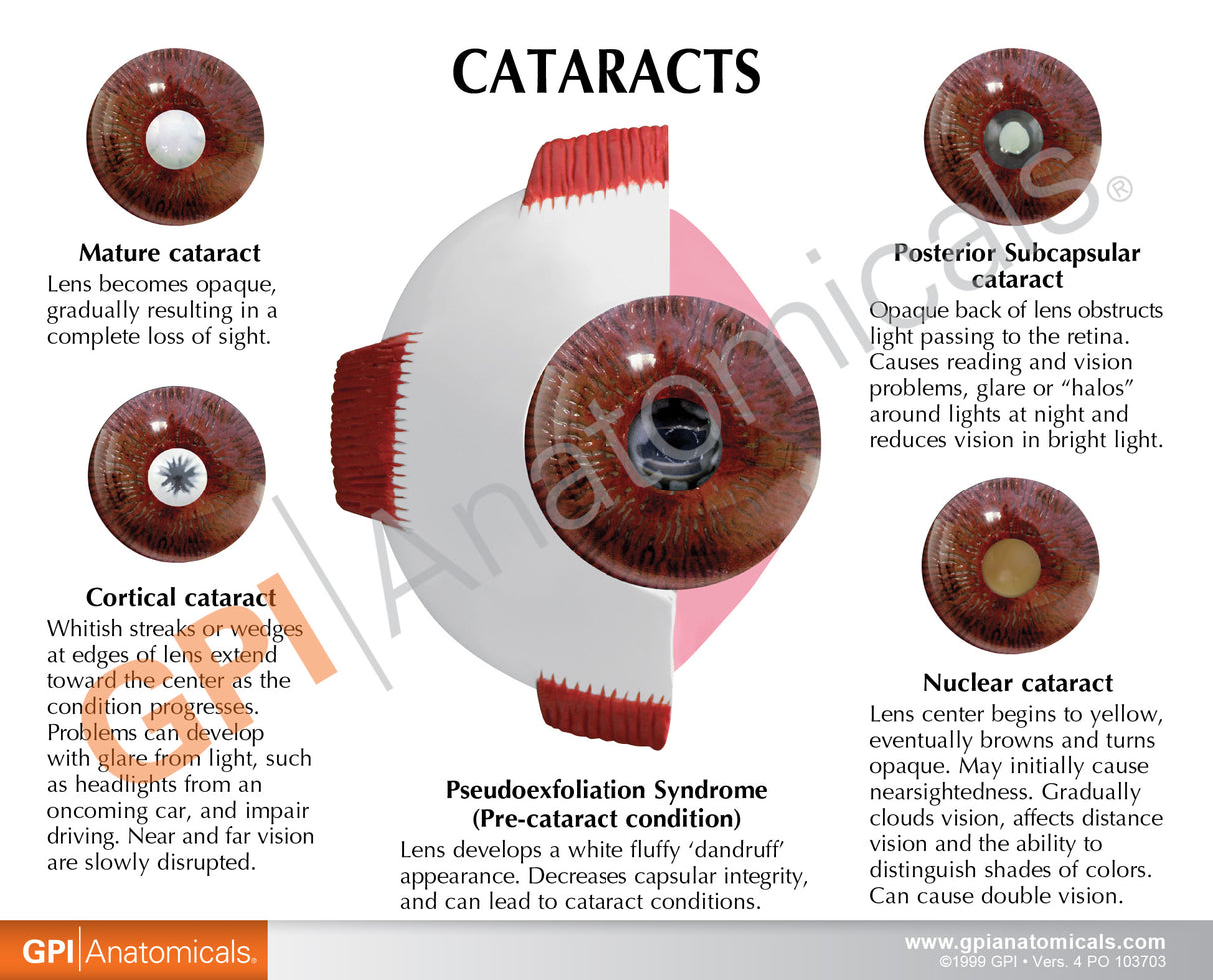 Cataract Eye Model