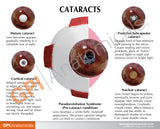 Cataract Eye Model