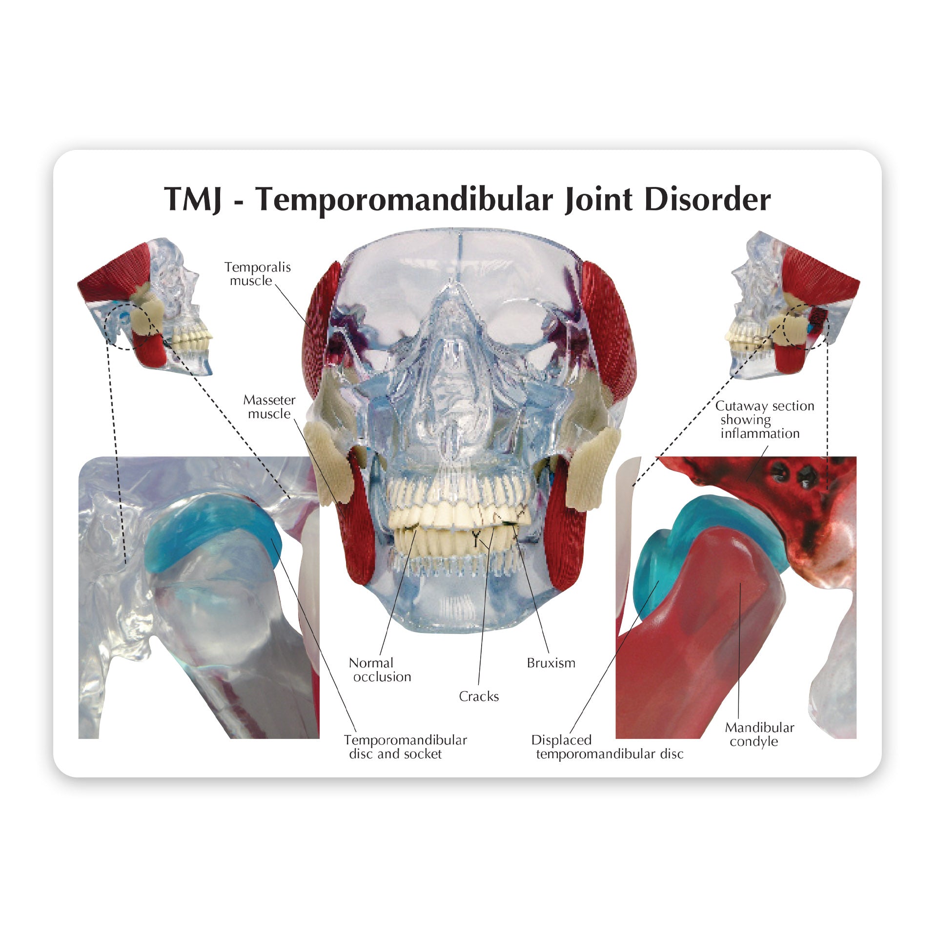 Temporomandibular Joint (TMJ) Model – GPI 3D Anatomy