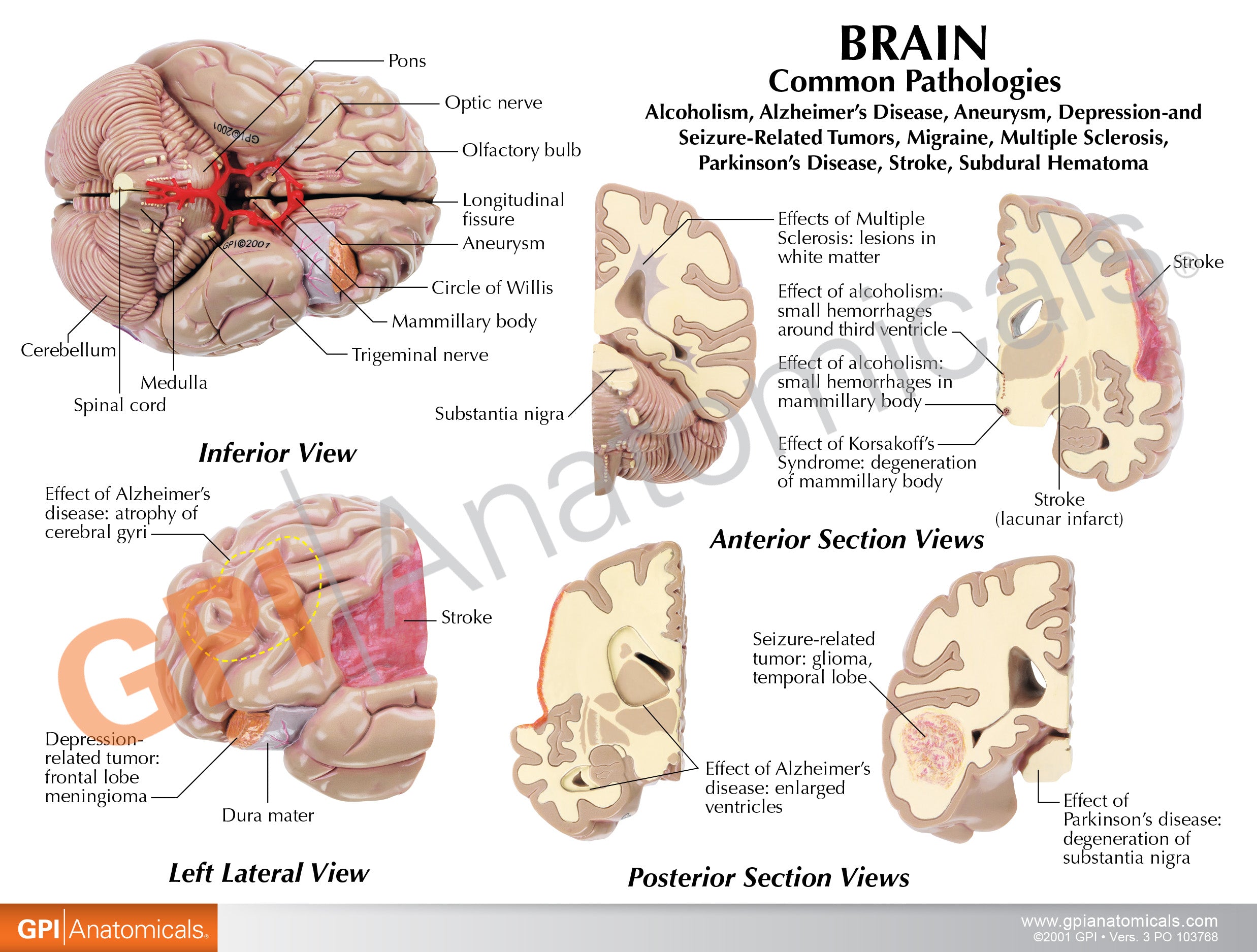 Brain with Partial Skull Model – GPI 3D Anatomy